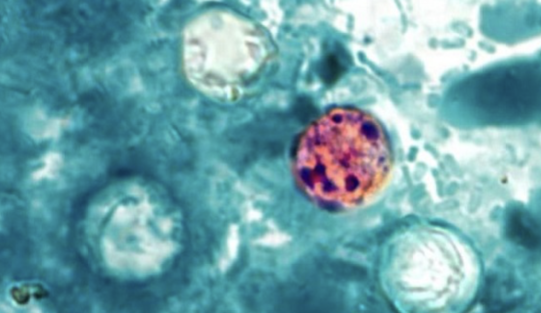 State-by-state count in parasitic outbreak continues to increase