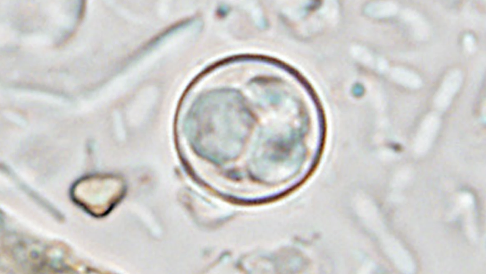 Some states say Cyclospora outbreak is slowing